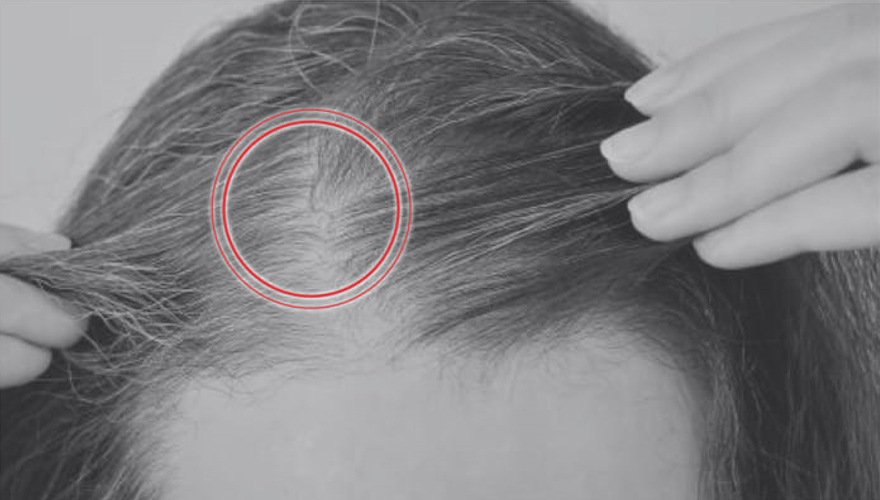 folicles